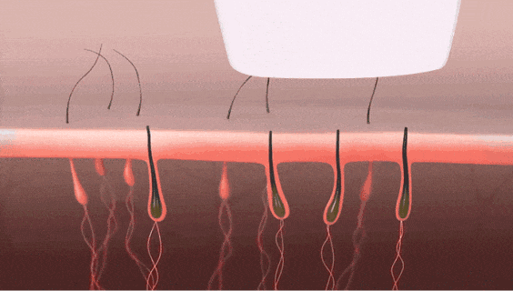 光子美容儀脫毛效果圖 光子美容儀脫毛效果圖